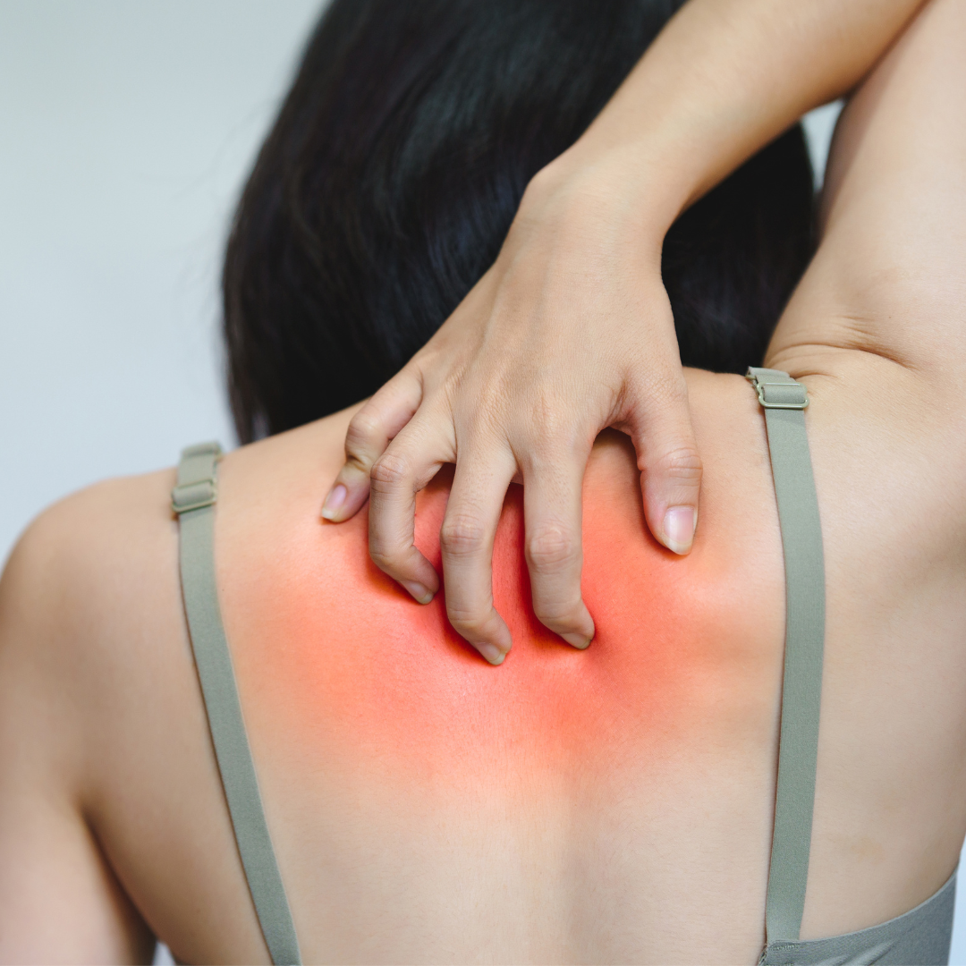 What is histamine intolerance?
